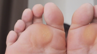 　【永澤ゆきの】バレエで鍛えて出来た足裏の皮膚の変色を見て。